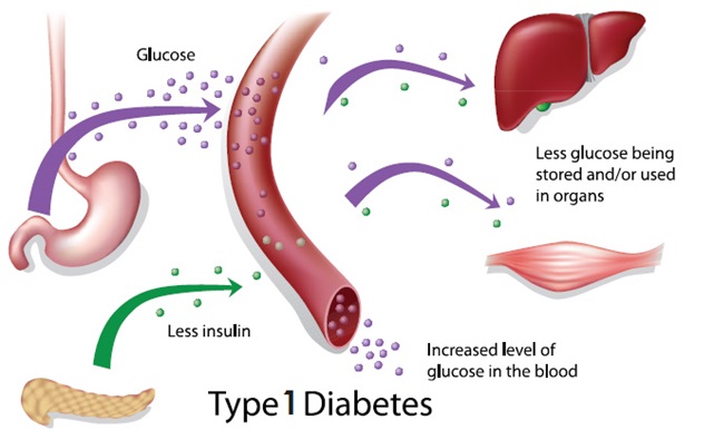 type-I-diabetes